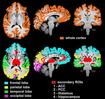 Type 1 Diabetes and Impaired Awareness of Hypoglycemia Are Associated with Reduced Brain Gray Matter Volumes